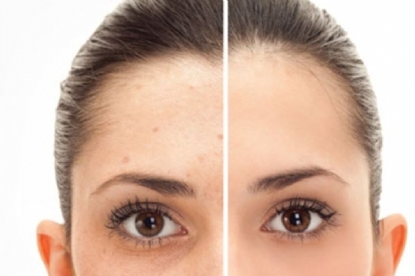 Products for anti-pigmentation spots Products for anti-pigmentation spots